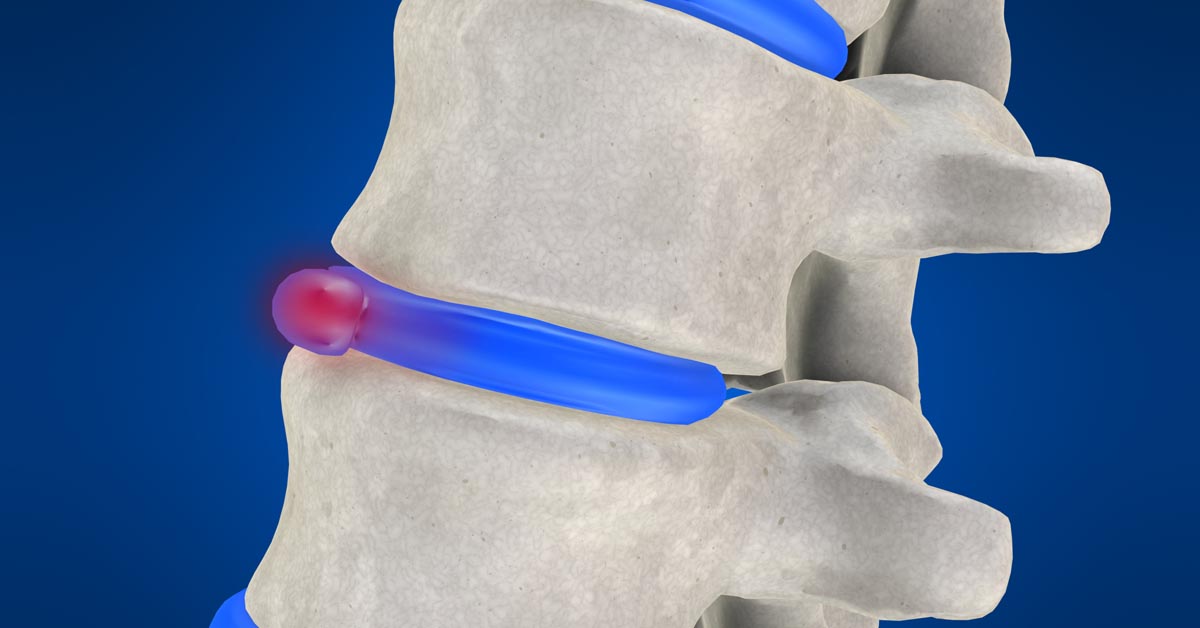 West New York non-surgical disc herniation treatment